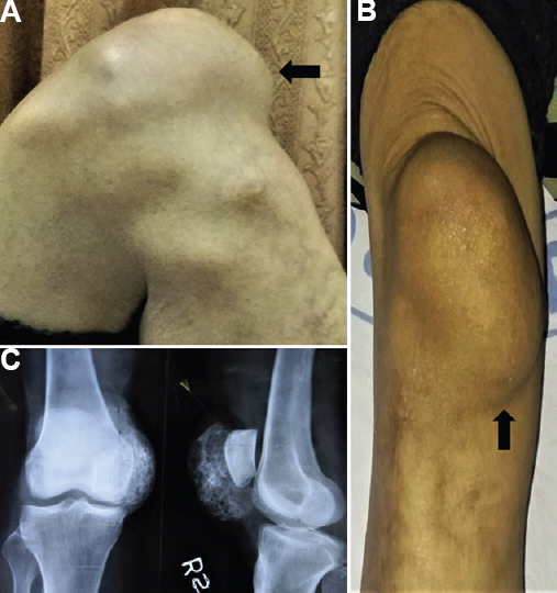 (A and B) The clinical image of a lump over the patella with no effect on knee flexion and extension (arrows). (C) The radiograph showing a lesion with well-defined radio-opacity overlying patella which appears to have neither apparent association with patella nor any anatomical alteration in the patella noted.